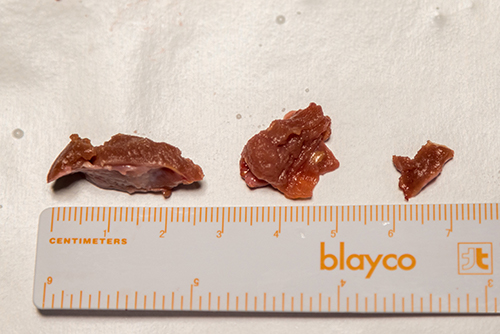 Surgical treatment brings the best outcomes in terms of relieving symptoms and reversing progressive HF/heart failure caused by HOCM