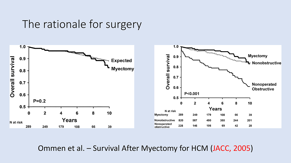 Septal myectomy or Alcohol septal ablation?